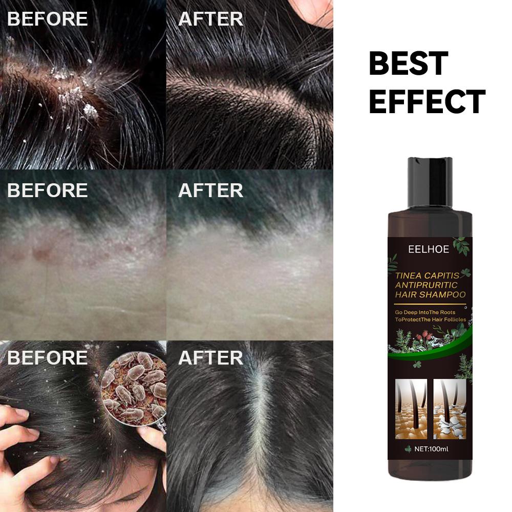 EELHOE Anti-Dandruff Shampoo – Itch Relief, Oil Control & Hair Loss Prevention Treatment for Flake-Free, Healthy Scalp (1pc / 2pcs Set) (USA)