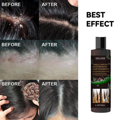 EELHOE Anti-Dandruff Shampoo – Itch Relief, Oil Control & Hair Loss Prevention Treatment for Flake-Free, Healthy Scalp (1pc / 2pcs Set) (USA)